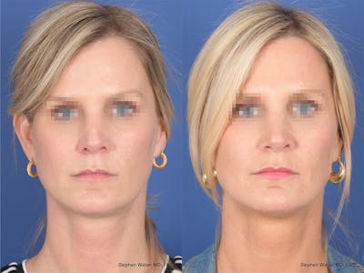 Revision Rhinoplasty Before & After Gallery - Patient 320354 - Image 1
