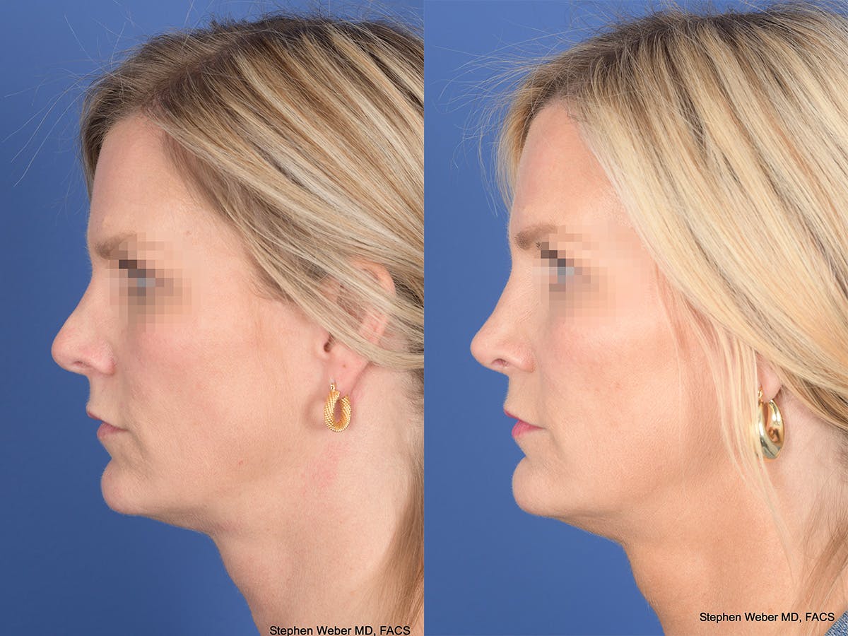 Revision Rhinoplasty Before & After Gallery - Patient 320354 - Image 2