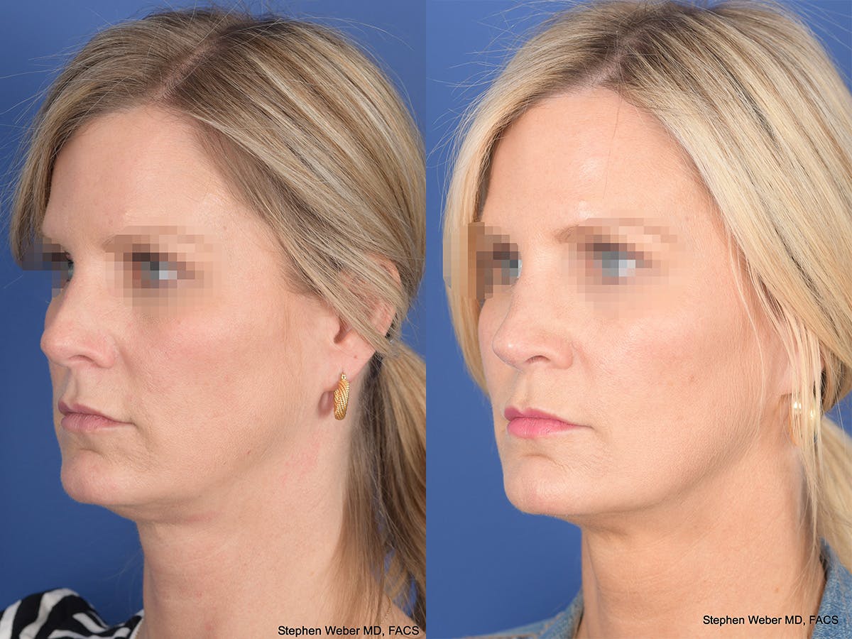 Revision Rhinoplasty Before & After Gallery - Patient 320354 - Image 3