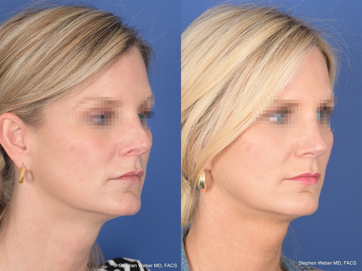 Revision Rhinoplasty Before & After Gallery - Patient 320354 - Image 4