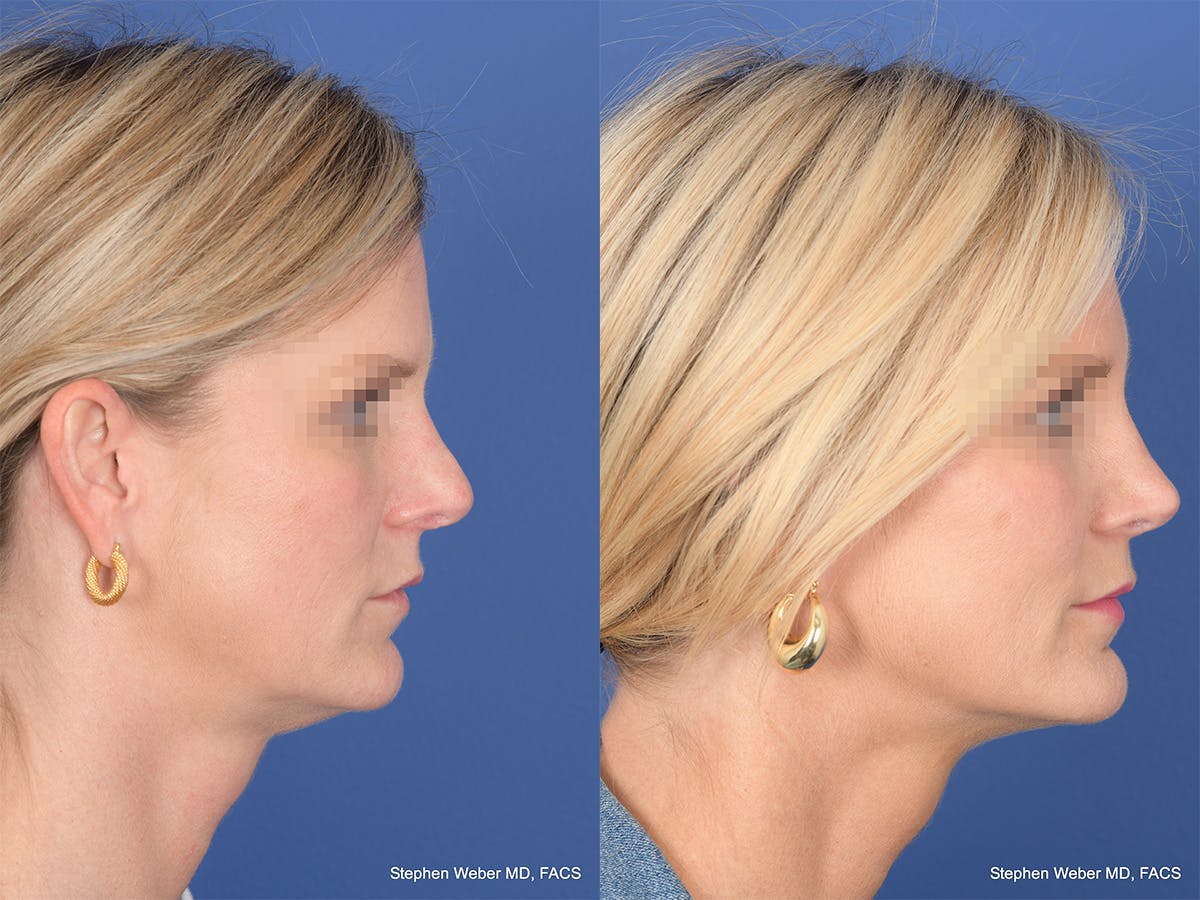 Revision Rhinoplasty Before & After Gallery - Patient 320354 - Image 5