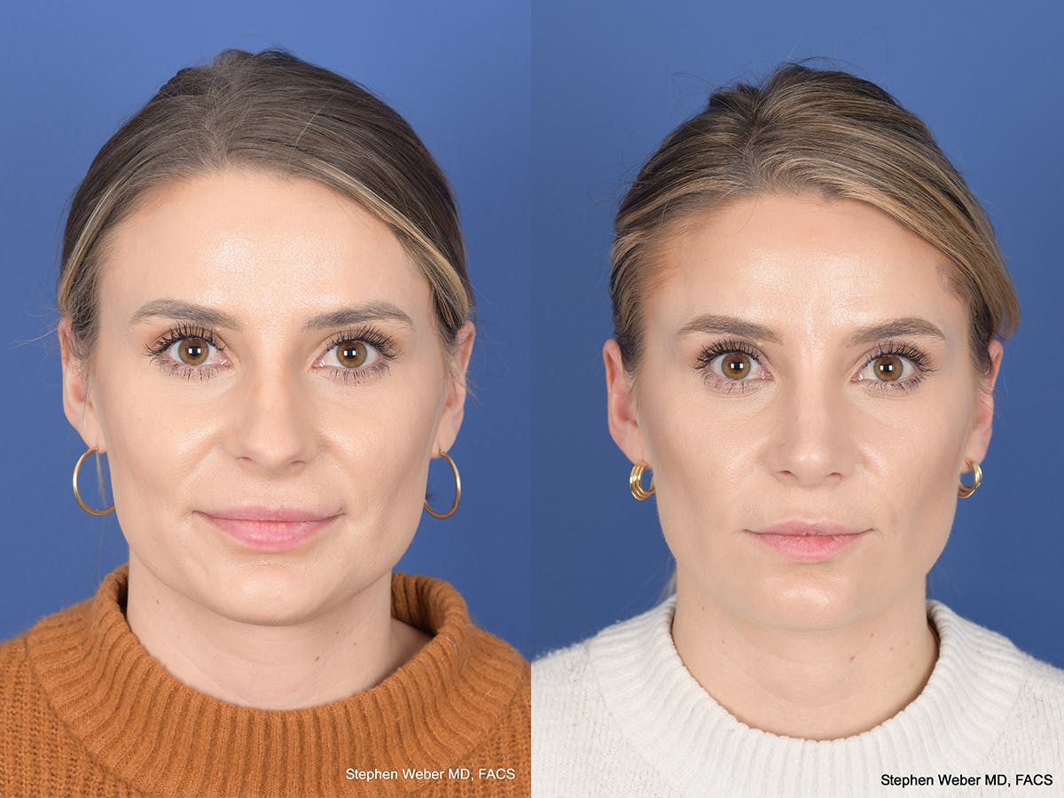 Revision Rhinoplasty Before & After Gallery - Patient 382631 - Image 1