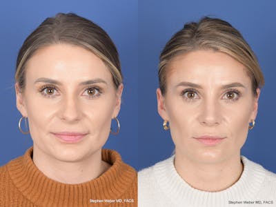 Revision Rhinoplasty Before & After Gallery - Patient 382631 - Image 1
