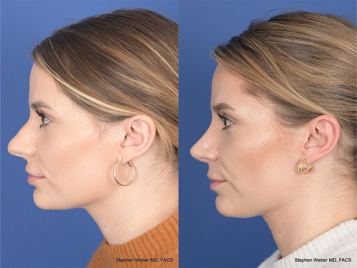 Revision Rhinoplasty Before & After Gallery - Patient 382631 - Image 2