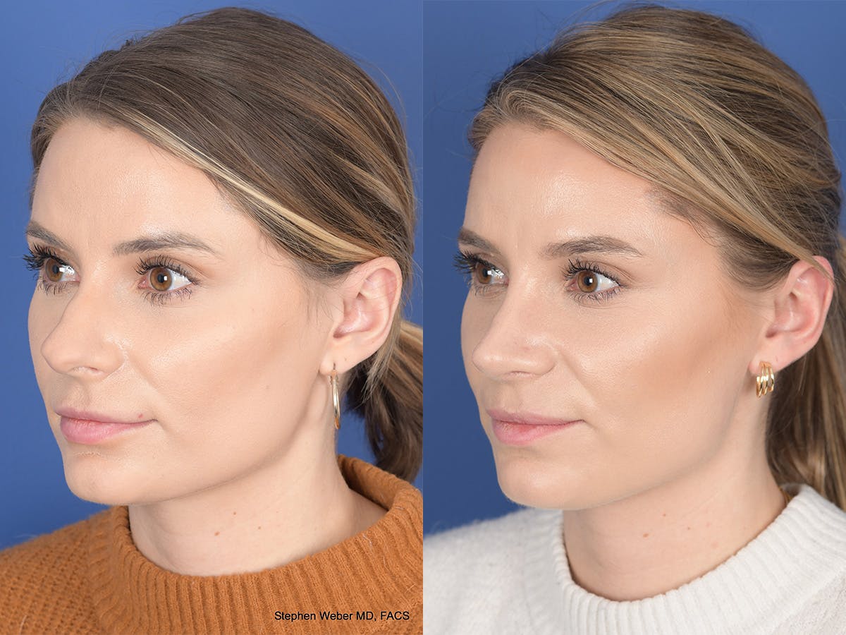 Revision Rhinoplasty Before & After Gallery - Patient 382631 - Image 3