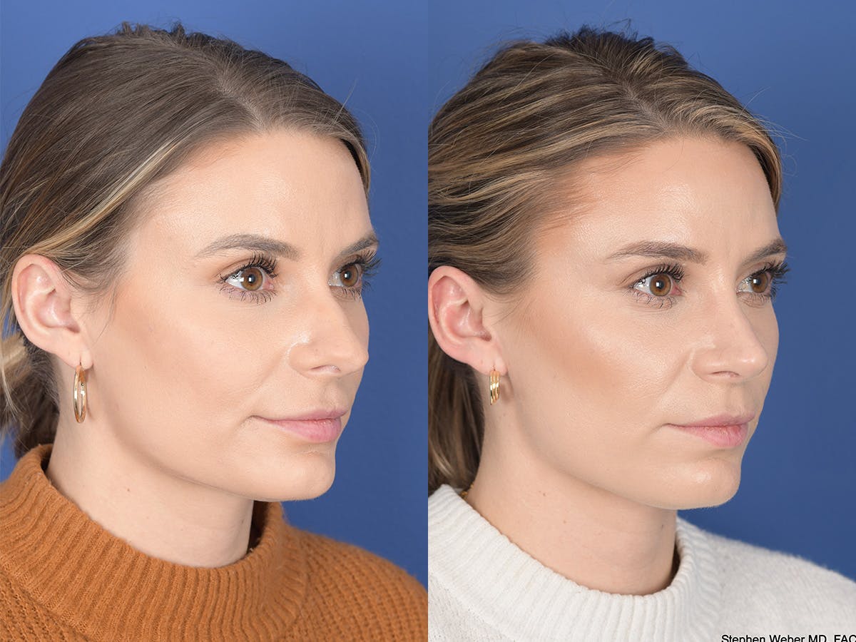 Revision Rhinoplasty Before & After Gallery - Patient 382631 - Image 4