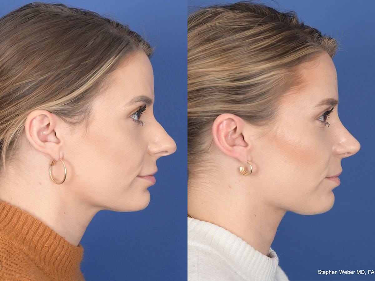 Revision Rhinoplasty Before & After Gallery - Patient 382631 - Image 5