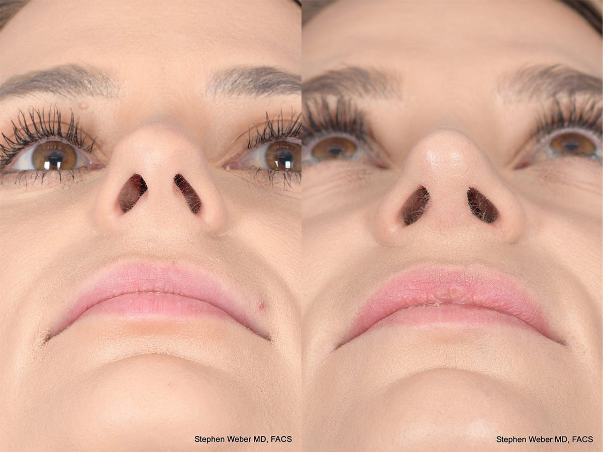 Revision Rhinoplasty Before & After Gallery - Patient 382631 - Image 6