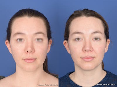 Revision Rhinoplasty Before & After Gallery - Patient 109018 - Image 1