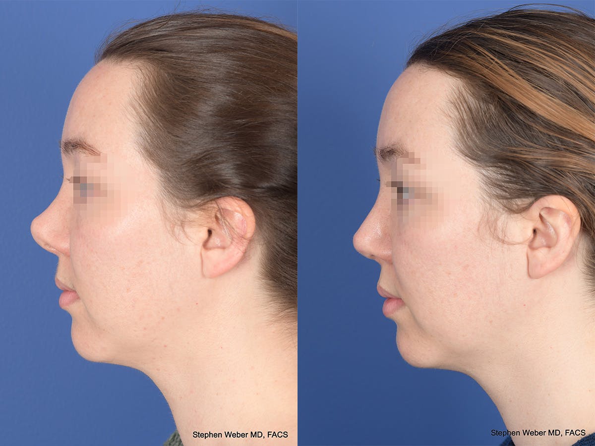 Revision Rhinoplasty Before & After Gallery - Patient 109018 - Image 2
