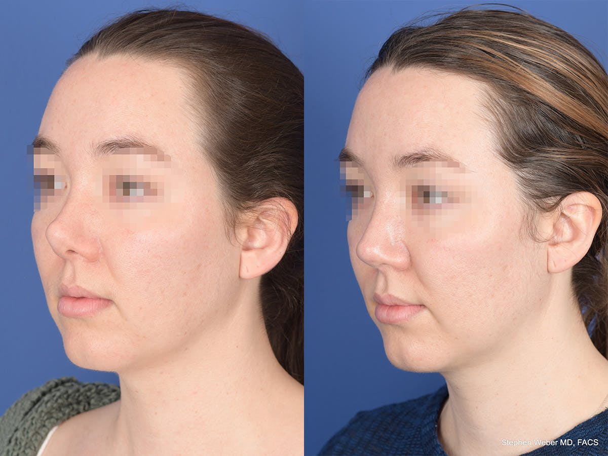 Revision Rhinoplasty Before & After Gallery - Patient 109018 - Image 3