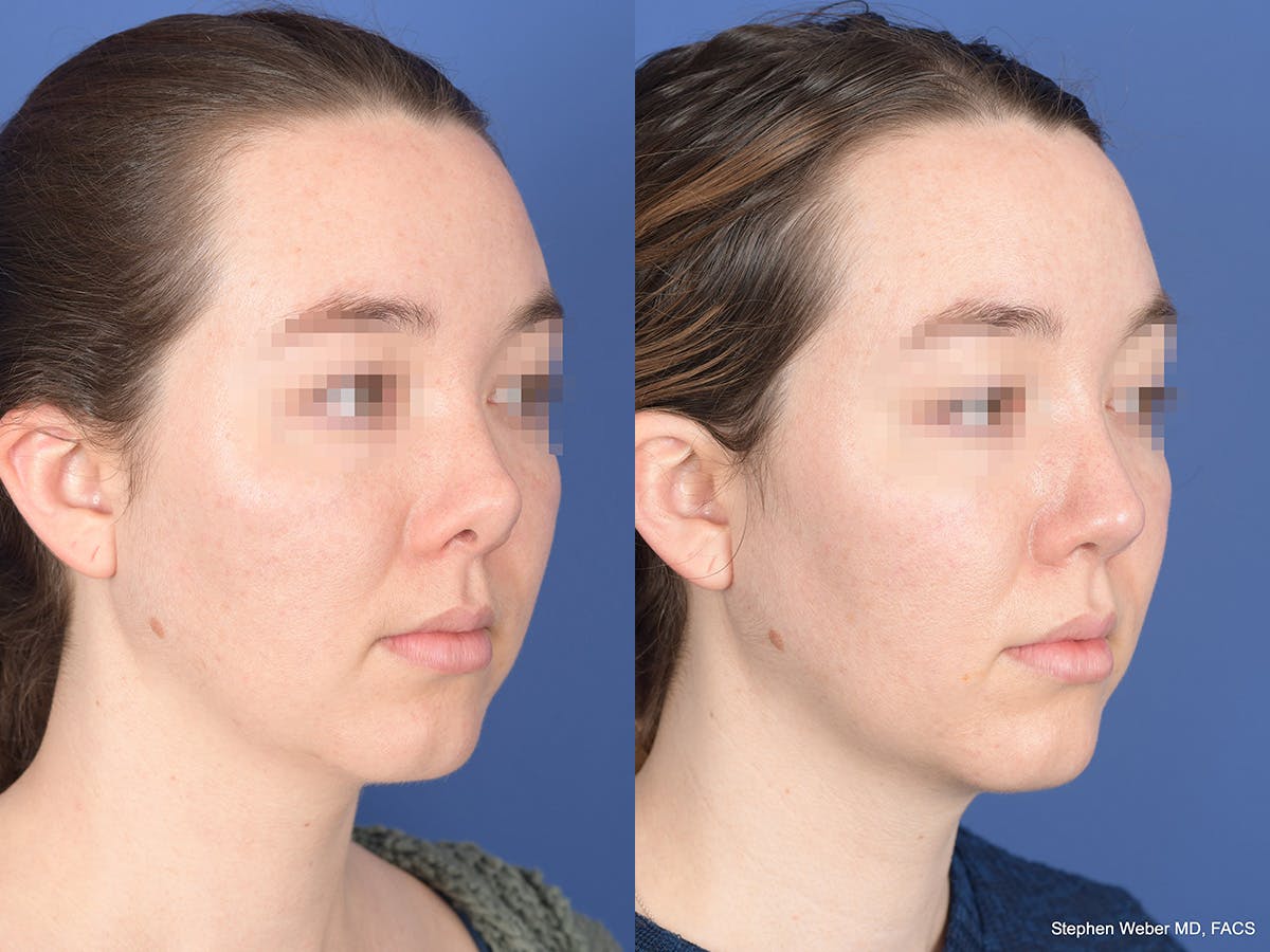 Revision Rhinoplasty Before & After Gallery - Patient 109018 - Image 4