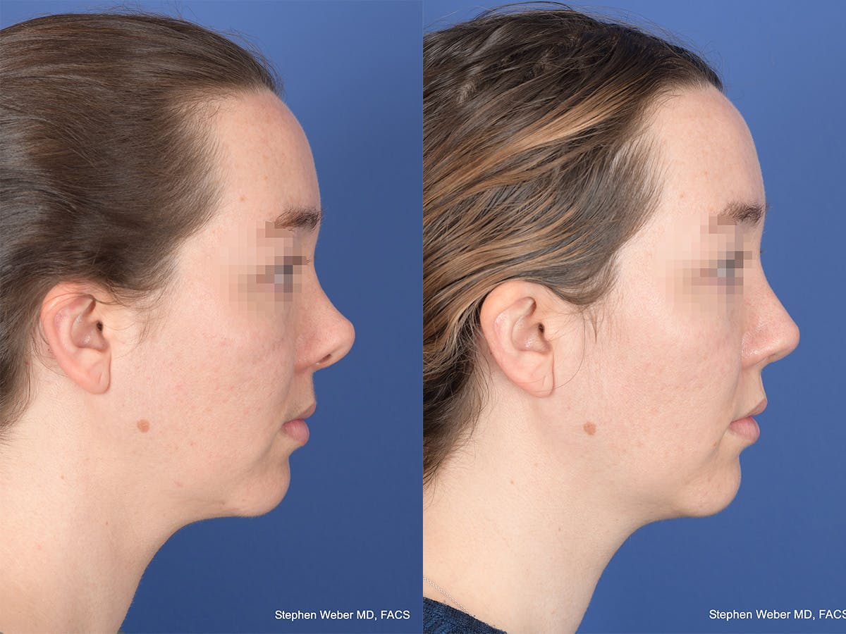Revision Rhinoplasty Before & After Gallery - Patient 109018 - Image 5