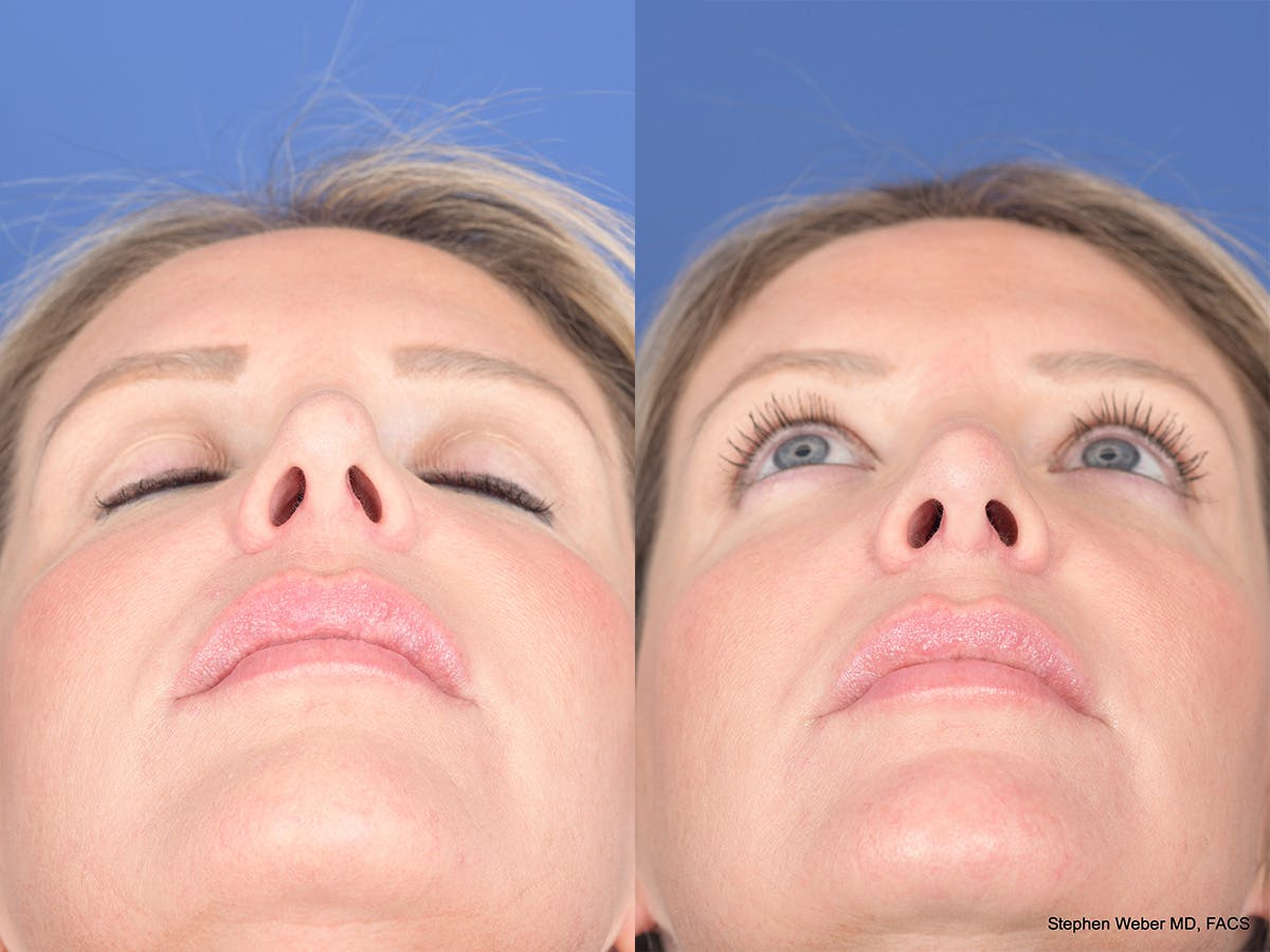 Revision Rhinoplasty Before & After Gallery - Patient 109018 - Image 6