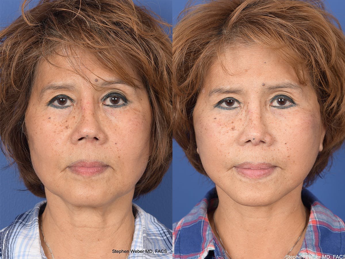 Revision Rhinoplasty Before & After Gallery - Patient 233088 - Image 1