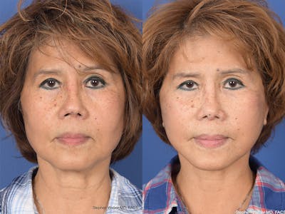 Revision Rhinoplasty Before & After Gallery - Patient 233088 - Image 1
