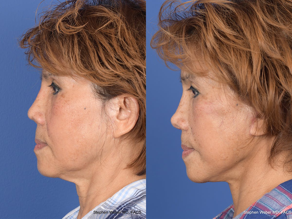 Revision Rhinoplasty Before & After Gallery - Patient 233088 - Image 2