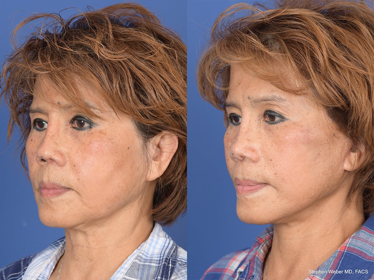Revision Rhinoplasty Before & After Gallery - Patient 233088 - Image 3
