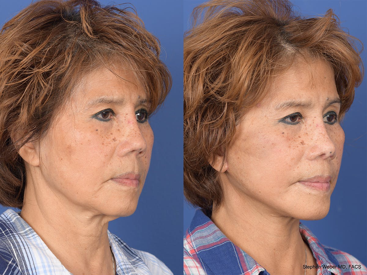 Revision Rhinoplasty Before & After Gallery - Patient 233088 - Image 4