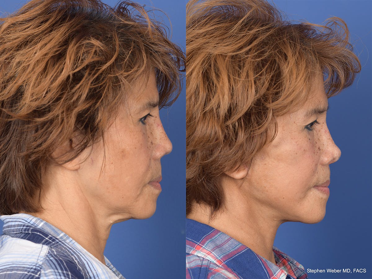 Revision Rhinoplasty Before & After Gallery - Patient 233088 - Image 5