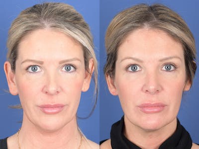 Revision Rhinoplasty Before & After Gallery - Patient 907711 - Image 1