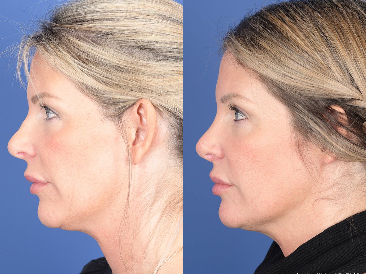 Revision Rhinoplasty Before & After Gallery - Patient 907711 - Image 2