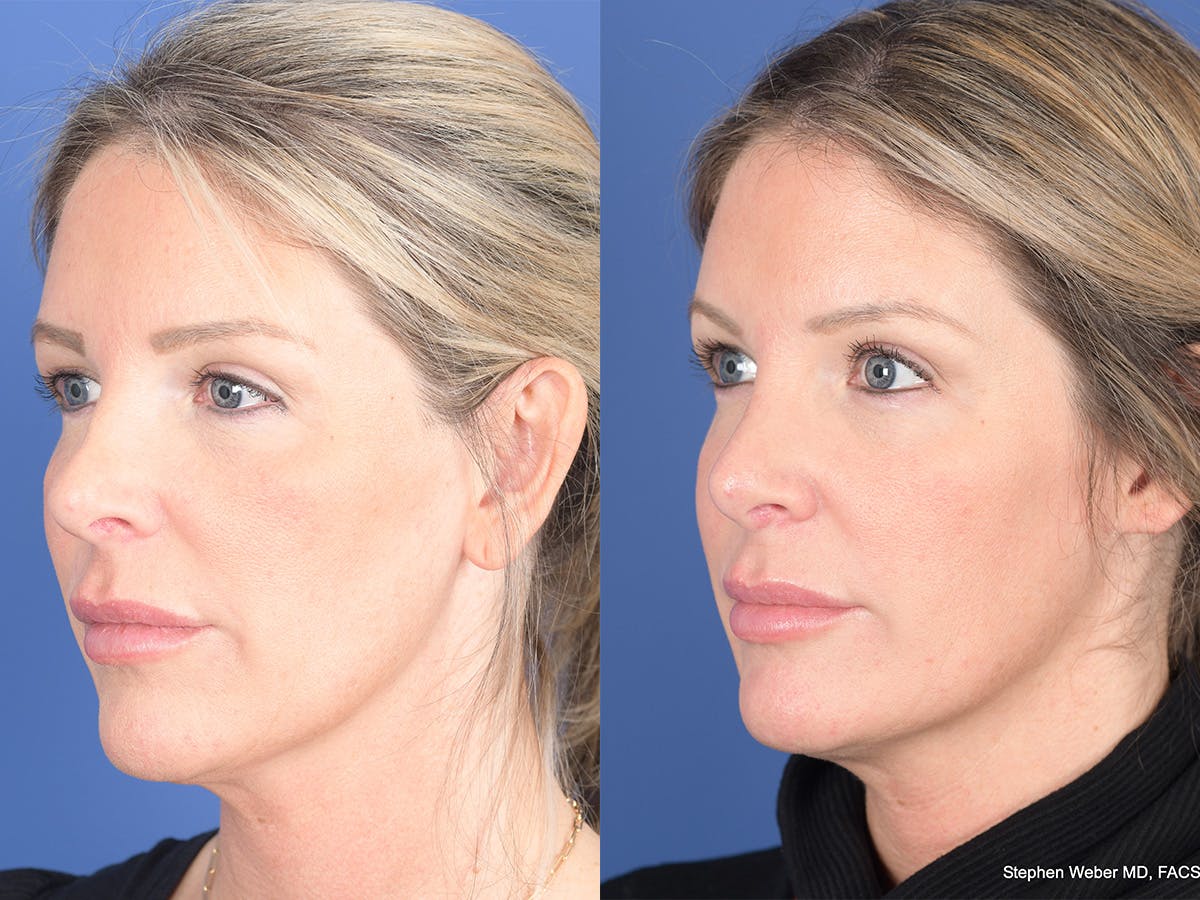 Revision Rhinoplasty Before & After Gallery - Patient 907711 - Image 3