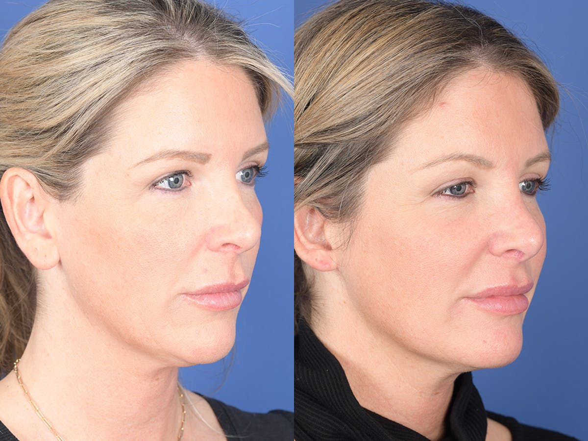 Revision Rhinoplasty Before & After Gallery - Patient 907711 - Image 4