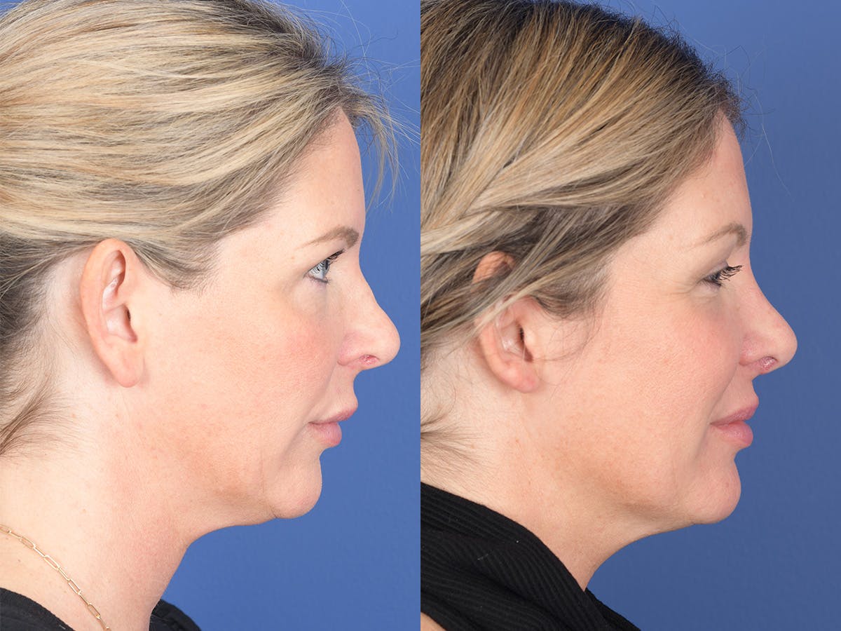 Revision Rhinoplasty Before & After Gallery - Patient 907711 - Image 5