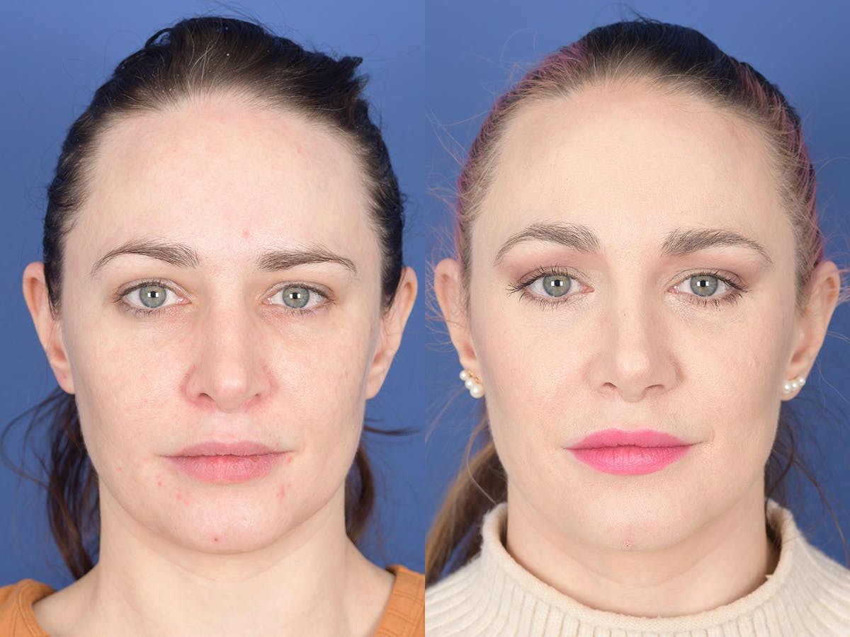 Revision Rhinoplasty Before & After Gallery - Patient 241031 - Image 1