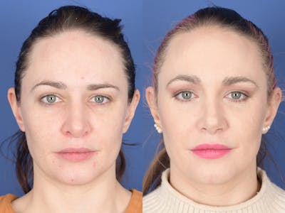 Revision Rhinoplasty Before & After Gallery - Patient 241031 - Image 1