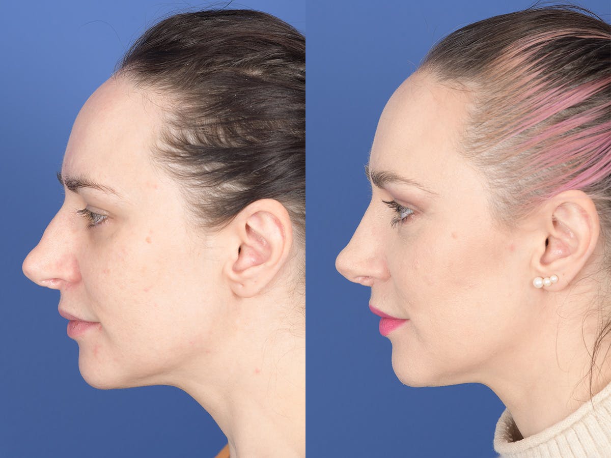 Revision Rhinoplasty Before & After Gallery - Patient 241031 - Image 2