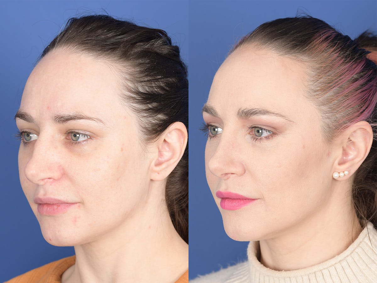 Revision Rhinoplasty Before & After Gallery - Patient 241031 - Image 3