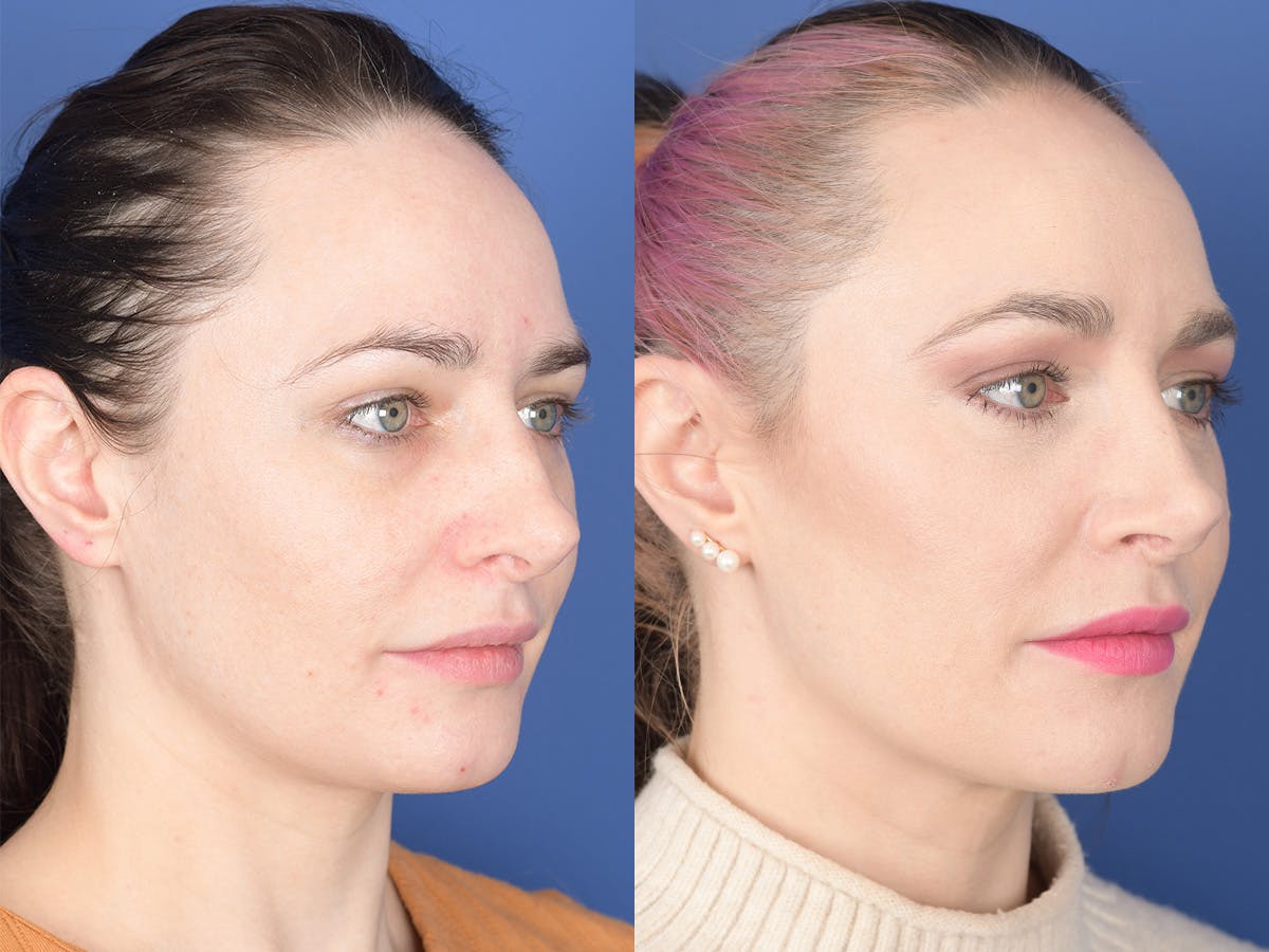 Revision Rhinoplasty Before & After Gallery - Patient 241031 - Image 4