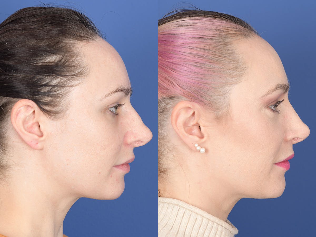 Revision Rhinoplasty Before & After Gallery - Patient 241031 - Image 5
