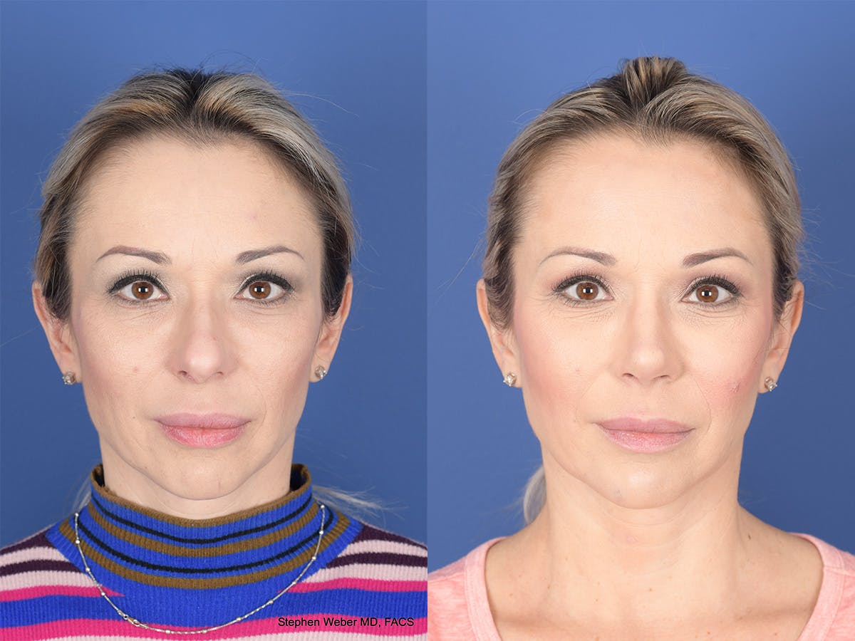 Revision Rhinoplasty Before & After Gallery - Patient 197130 - Image 1