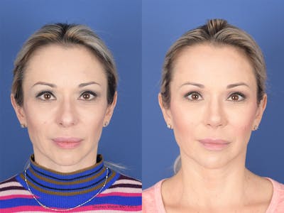 Revision Rhinoplasty Before & After Gallery - Patient 197130 - Image 1