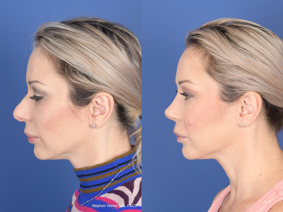 Revision Rhinoplasty Before & After Gallery - Patient 197130 - Image 2