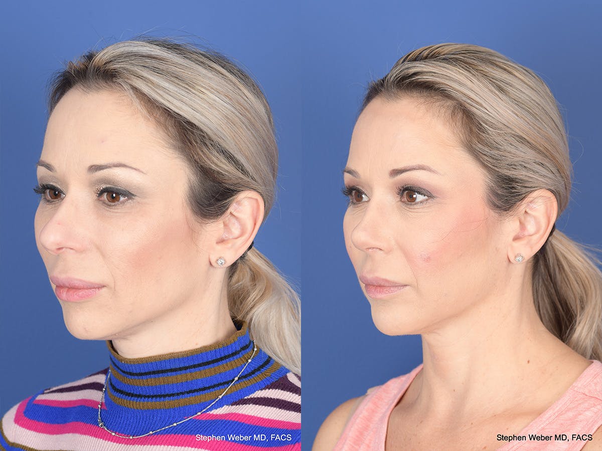 Revision Rhinoplasty Before & After Gallery - Patient 197130 - Image 3