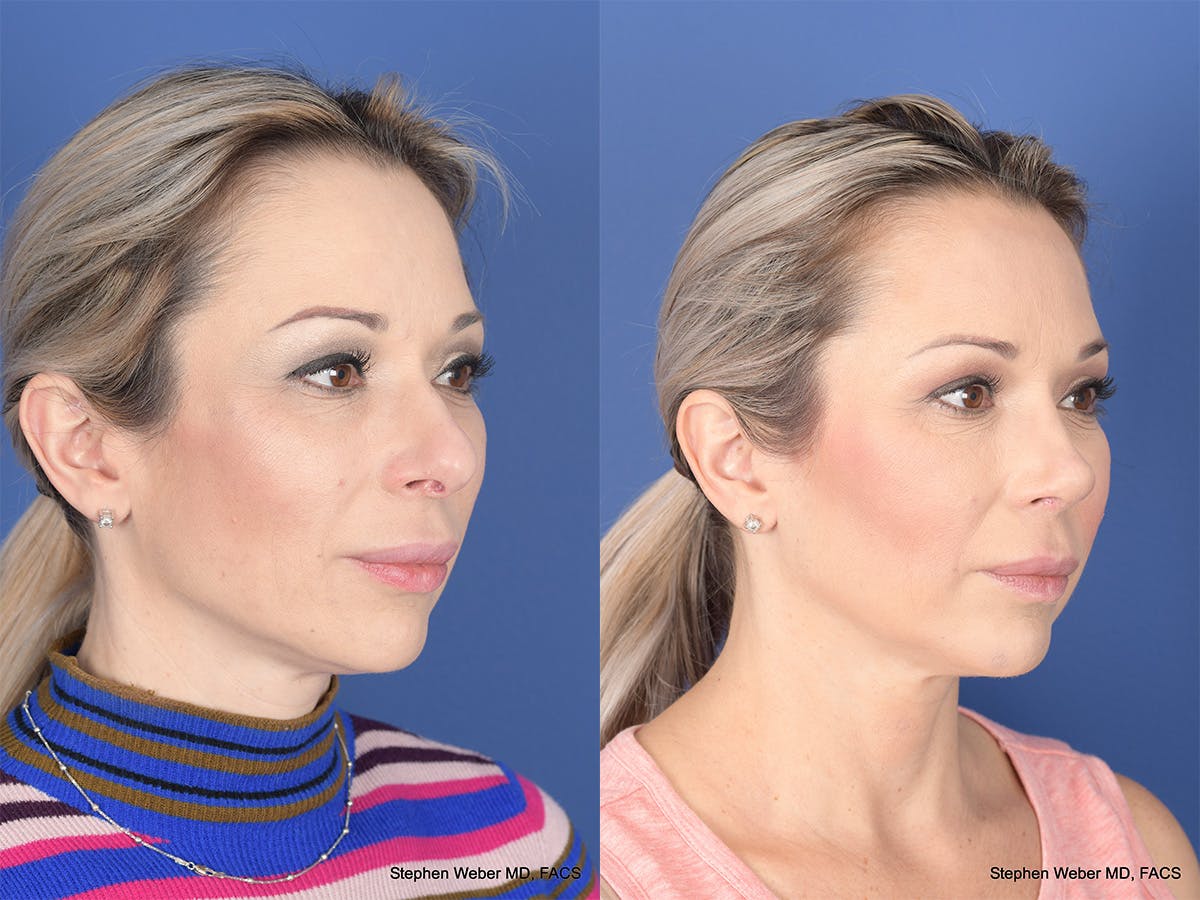 Revision Rhinoplasty Before & After Gallery - Patient 197130 - Image 4