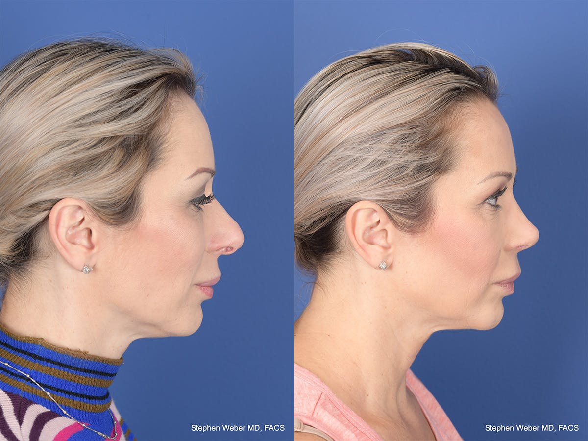 Revision Rhinoplasty Before & After Gallery - Patient 197130 - Image 5