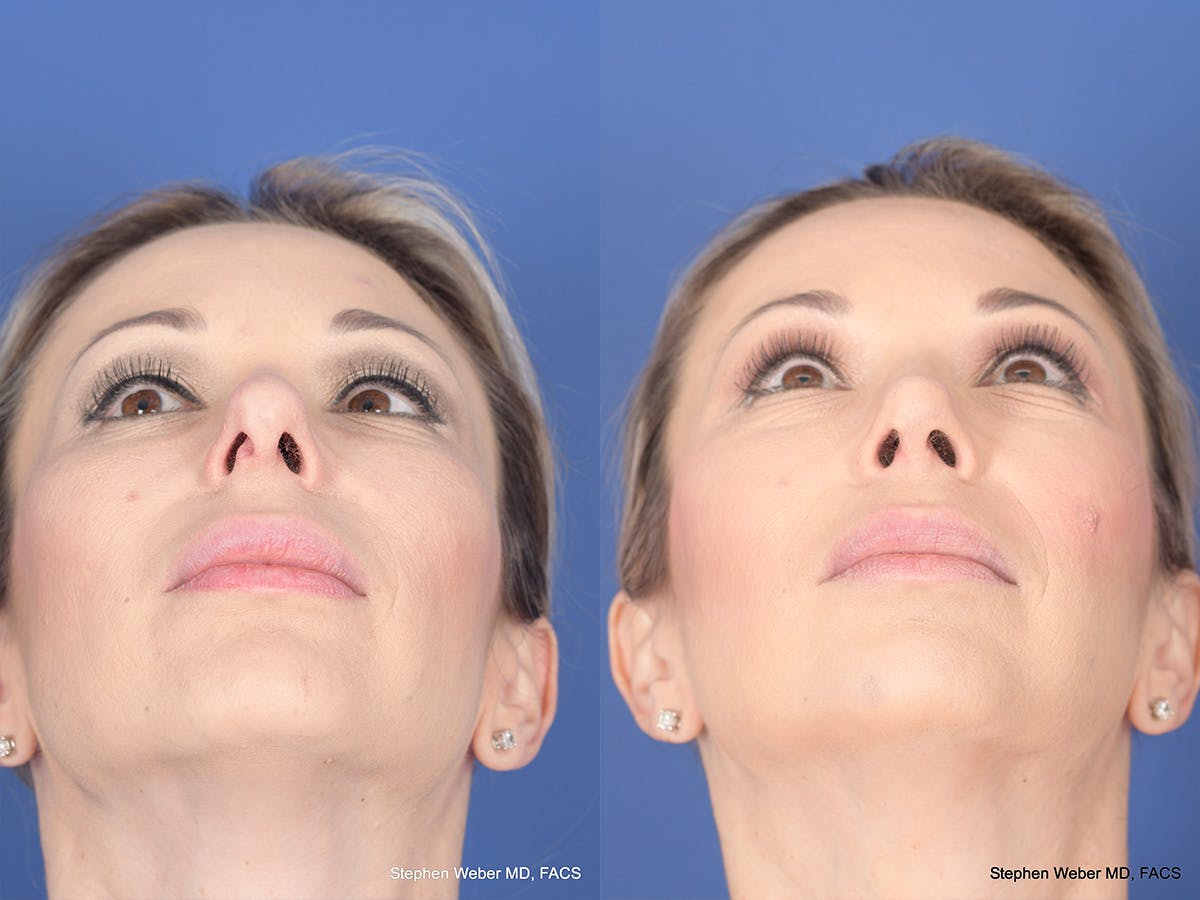 Revision Rhinoplasty Before & After Gallery - Patient 197130 - Image 6