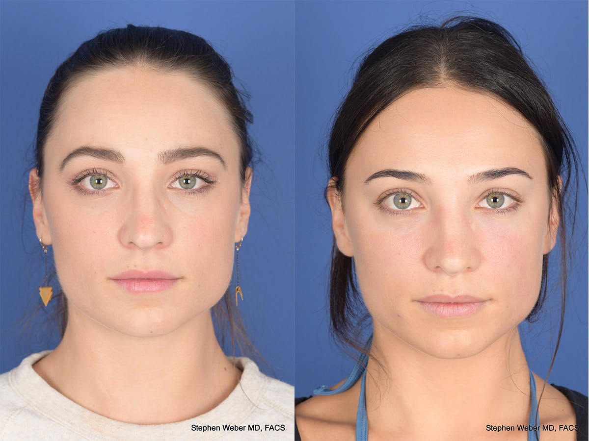 Revision Rhinoplasty Before & After Gallery - Patient 330256 - Image 1