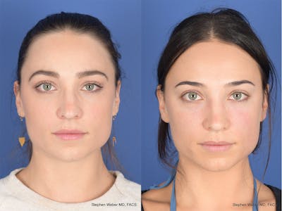 Revision Rhinoplasty Before & After Gallery - Patient 330256 - Image 1