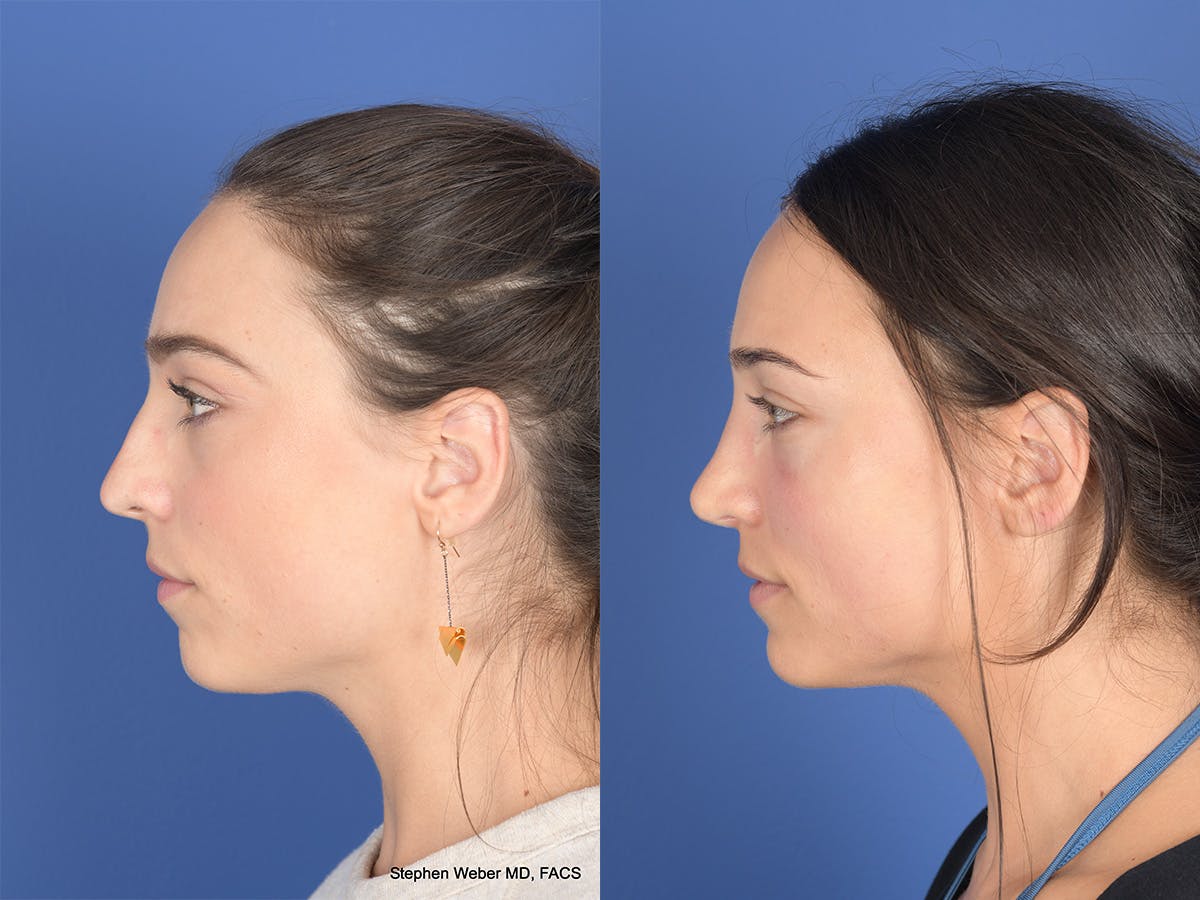 Revision Rhinoplasty Before & After Gallery - Patient 330256 - Image 2
