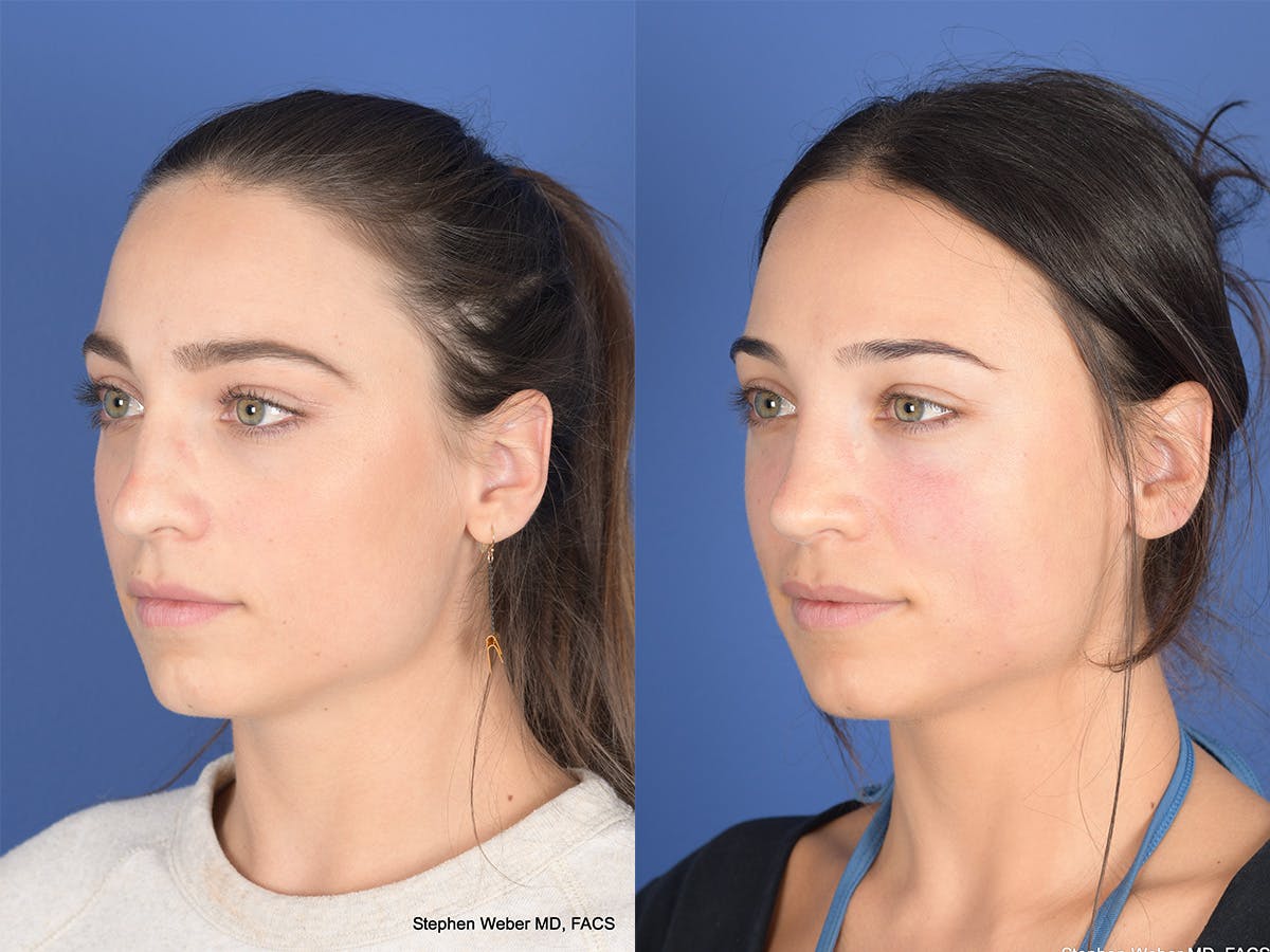 Revision Rhinoplasty Before & After Gallery - Patient 330256 - Image 3