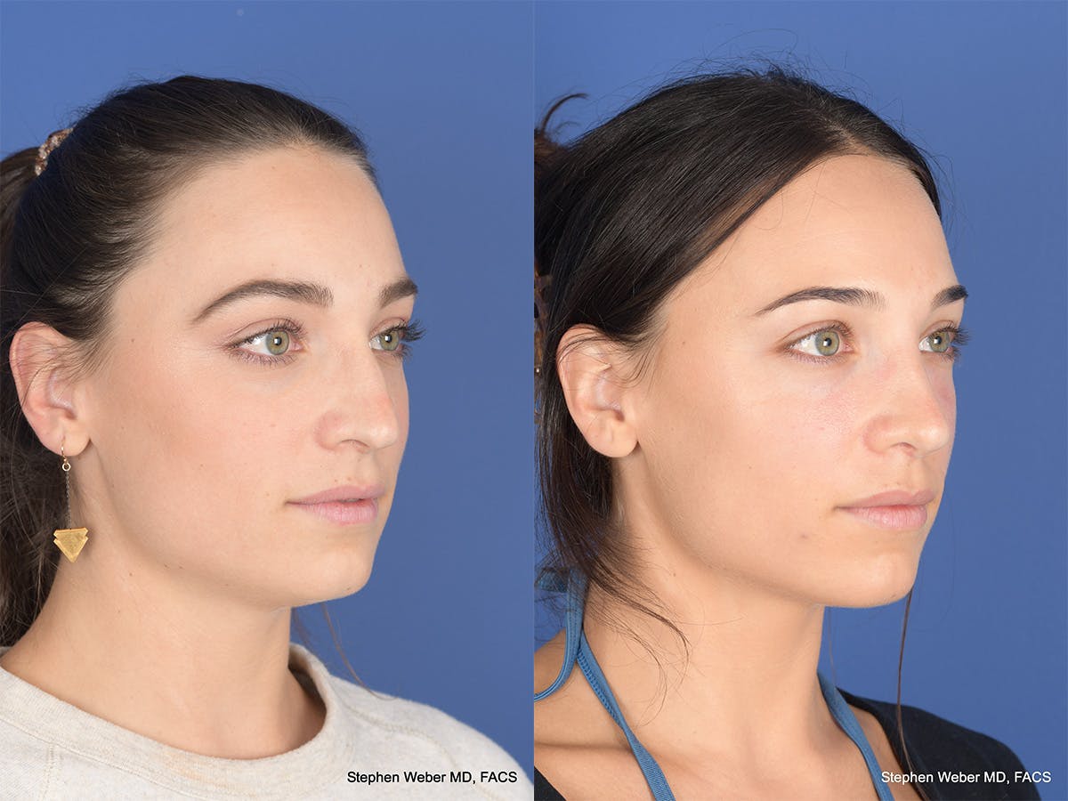 Revision Rhinoplasty Before & After Gallery - Patient 330256 - Image 4