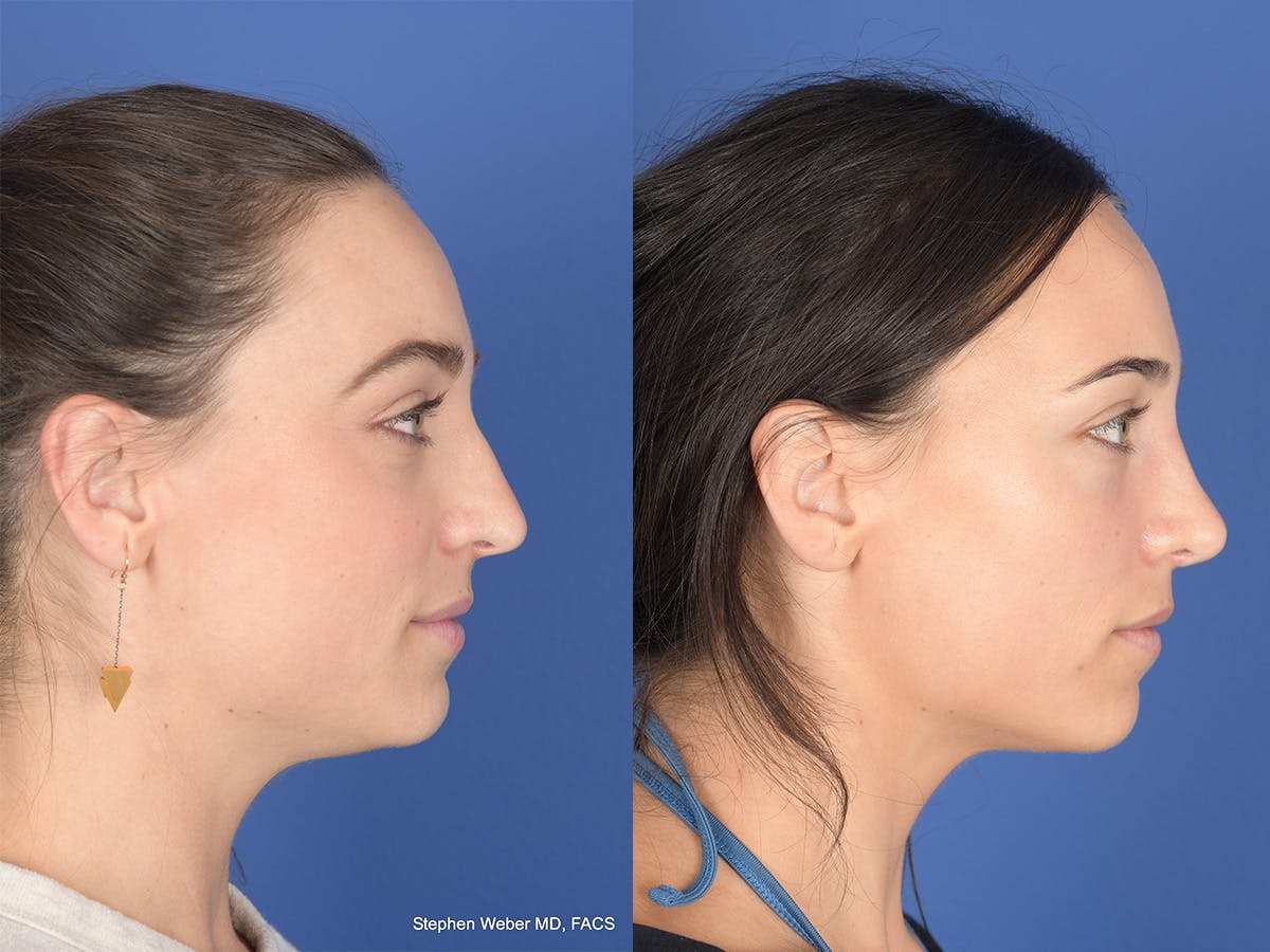 Revision Rhinoplasty Before & After Gallery - Patient 330256 - Image 5