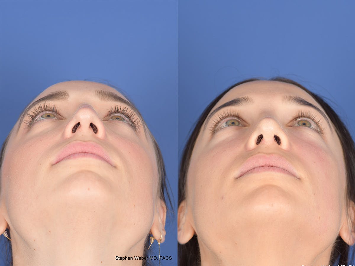 Revision Rhinoplasty Before & After Gallery - Patient 330256 - Image 6