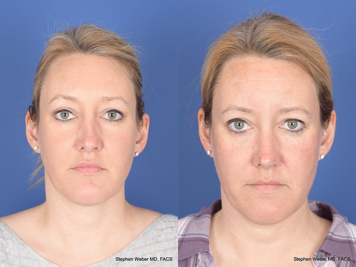 Revision Rhinoplasty Before & After Gallery - Patient 290268 - Image 1
